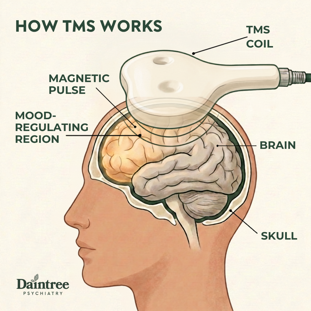How TMS works
